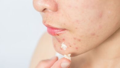 Acne: Qual influência a alimentação tem para a pele?