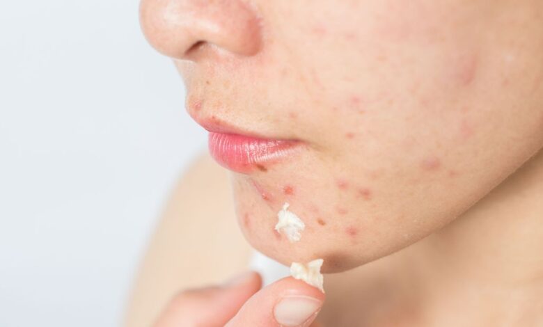 Acne: Qual influência a alimentação tem para a pele?